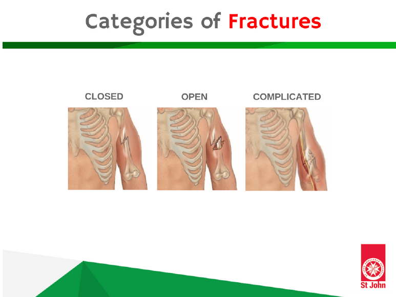 fracture meaning