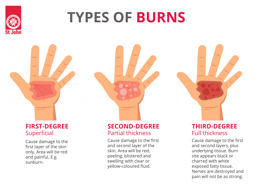 a second degree burn may develop blisters